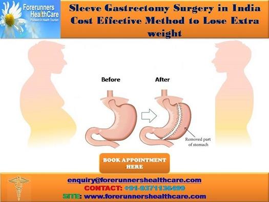 Sleeve Gastrectomy Surgery in India Cost Effective Method to Lose Extra weight