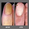 Laser Nail Fungus Clinic San Diego