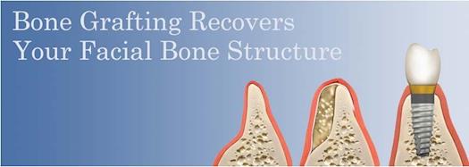 Bone grafting recovers your facial bone structure