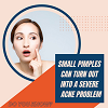 Small Pimples Can Turn Out Into A Severe Acne Problem.