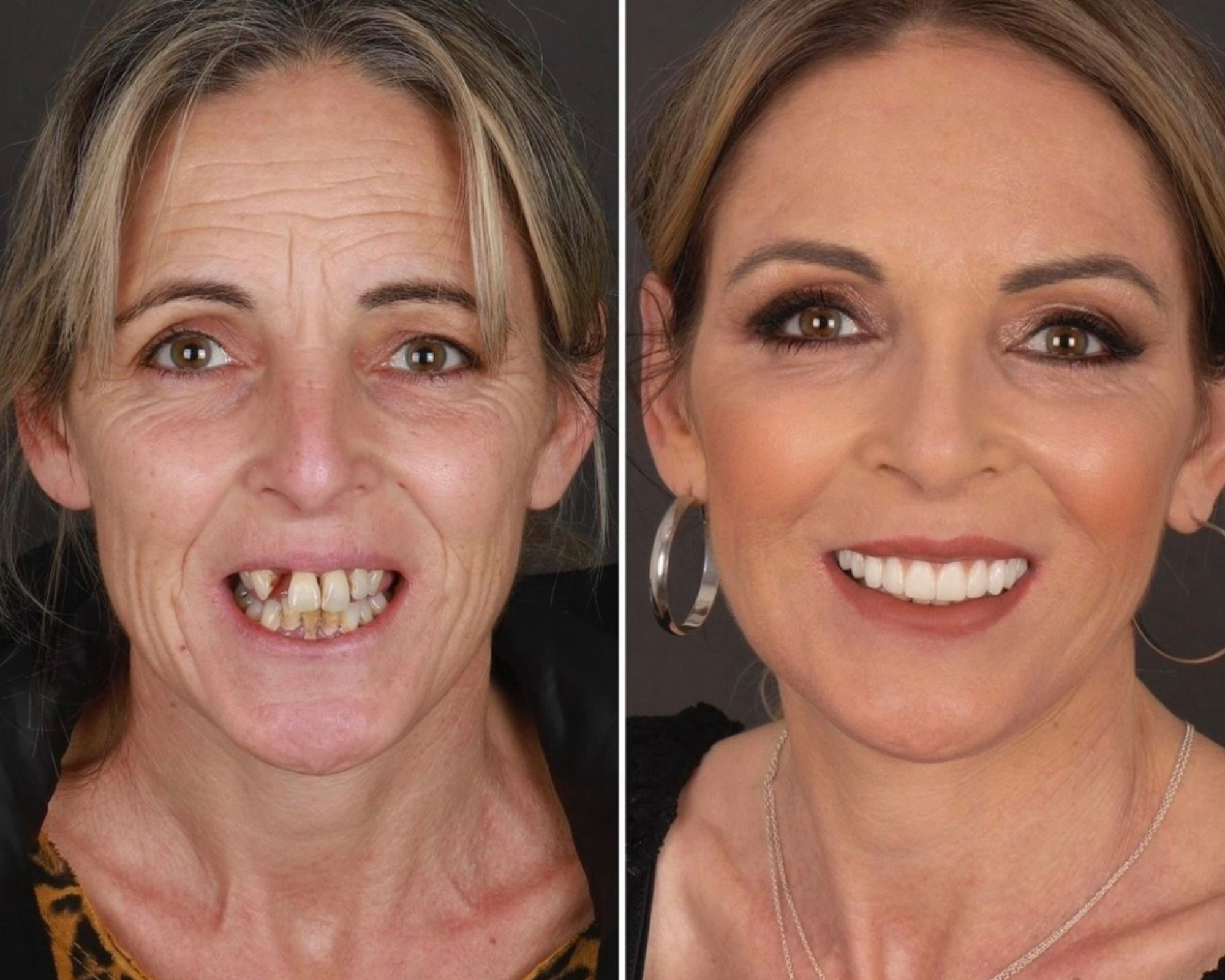 Get Pain-Free Wisdom Teeth Removal Services Near Charleston