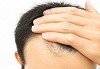Hair PRP Treatment in New Jersey