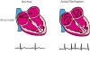 Atrial Fibrillation: A Heart Condition