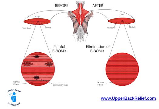Center For Upper Back Pain Relief