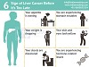 6 Sign of Liver Cancer Before it's Too Late
