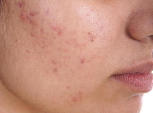 Ayurvedic treatment for Acne