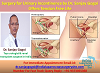 Surgery for Urinary Incontinence by Dr. Sanjay Gogoi 