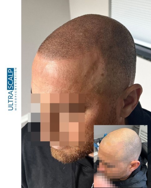 Ultra Scalp Micropigmentation