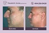 Risks and Potential Complications About Rhinoplasty Atlanta Ga