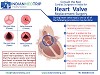 Consult the Best Cardiac Surgeon in India for Your Heart Valve Replacement Surgery