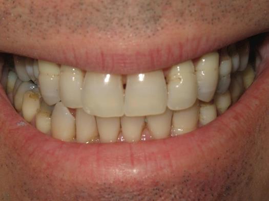 Before and After Photos of a Full Mouth Reconstruction