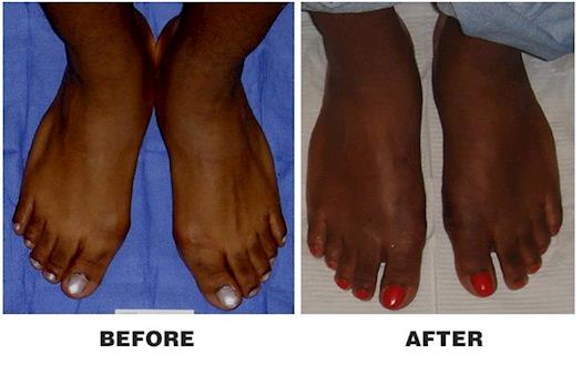 Before and After Bunion Surgery