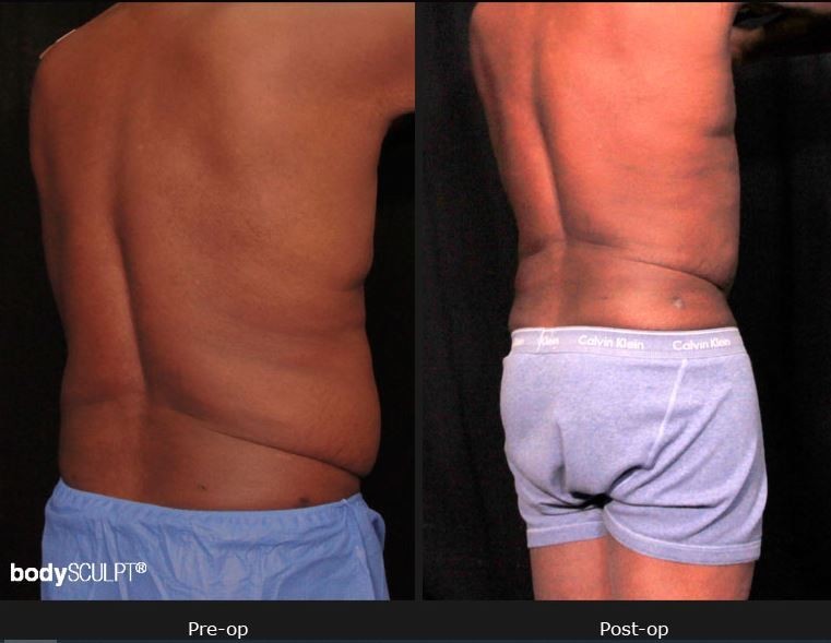 MALE BODY CONTOURING – BEFORE AND AFTER PHOTOS