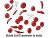 Sickle Cell Treatment