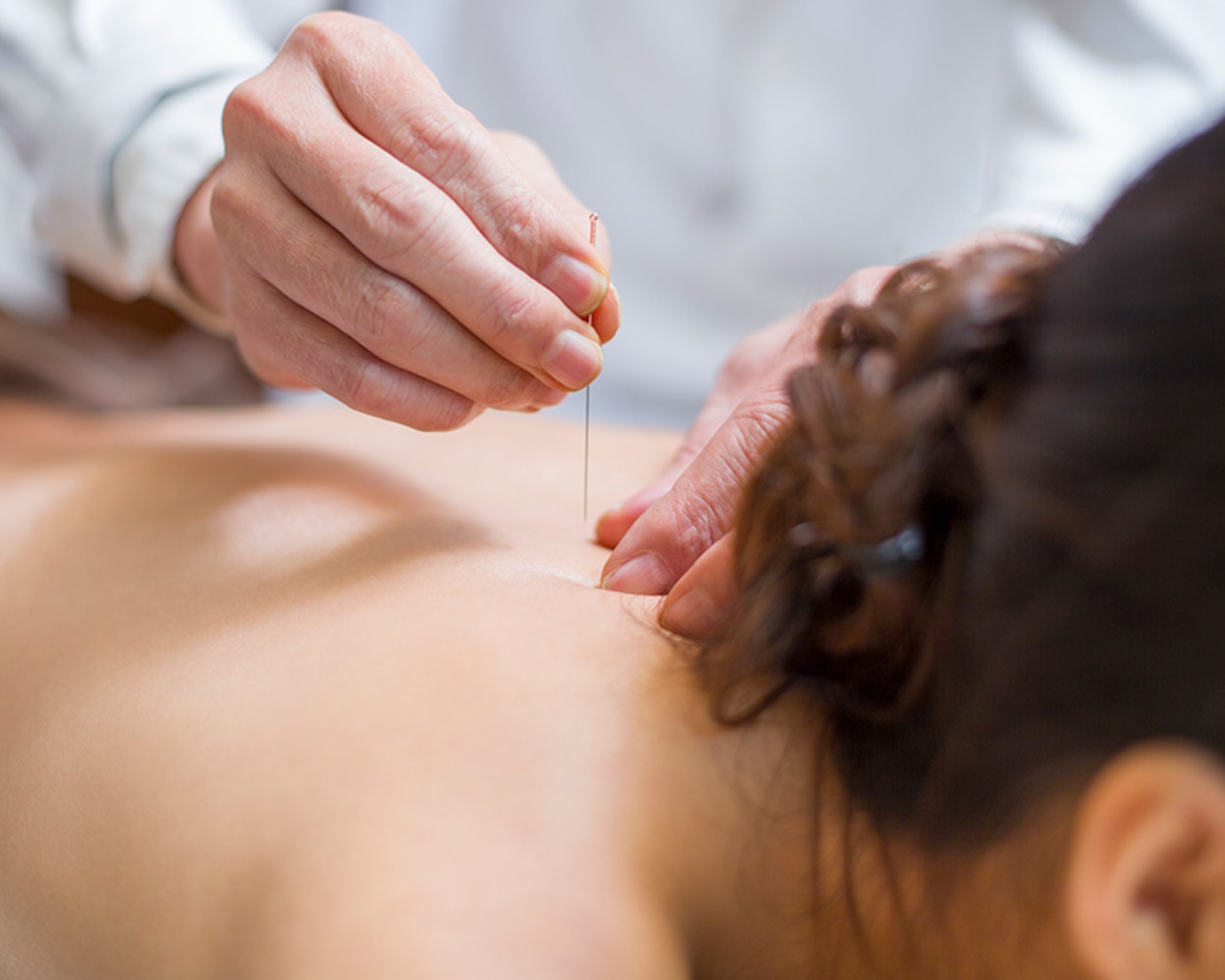 Top-Rated Acupuncture in Mt Pleasant, SC