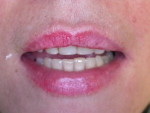 Are You Feeling Embarrassed of Smiling in Public?