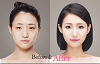 See Korean Plastic Surgery Before After