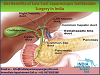 GET BENEFITS OF LOW COST LAPAROSCOPIC GALLBLADDER SURGERY IN INDIA