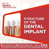 Best implantologist in dwarka | Dental implants in dwarka | High-Quality Dental Implants in Dwarka -