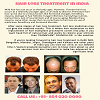  Hair Loss Treatment In India