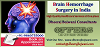 How can I get Successful affordable Brain Hemorrhage Surgery in India?