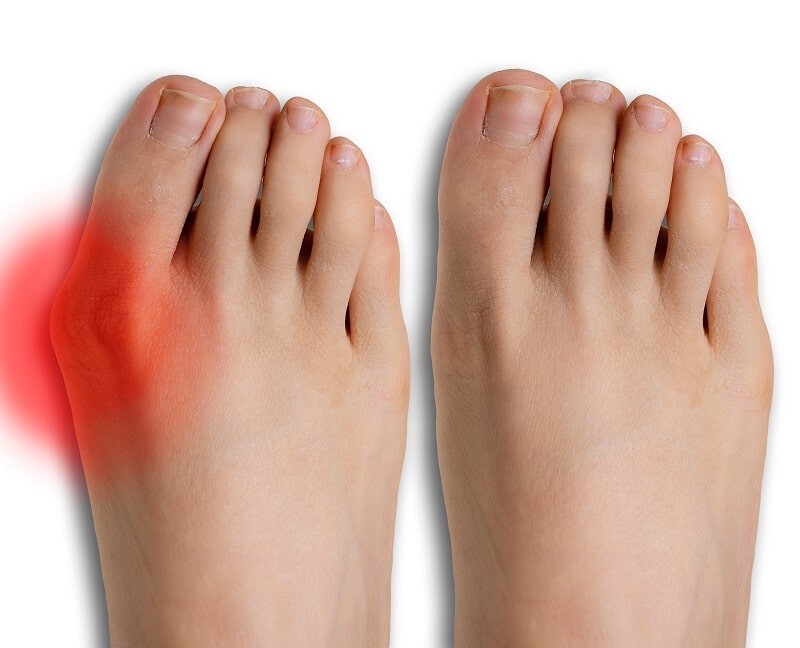 MINIMALLY INVASIVE BUNION SURGERY IN SINGAPORE - FOOT & ANKLE INJURY