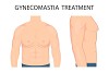 Thing you need to know about Gynecomastia Surgery – Stages, costs and types