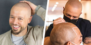 How Long Does Scalp Micropigmentation Take to Heal?