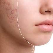 Transforming Skin: The Journey to Effective Acne Scar Treatment in Islamabad