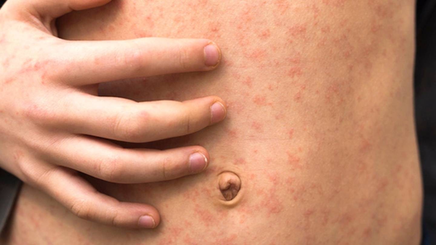 Travelers alerted of possible exposure to measles at SeaTac Airport