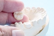 Dental Crowns 7 Surprising Facts You Should Know